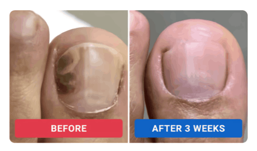 Orivelle Anti-Fungal Pen customer~~Elena S. –California, USA